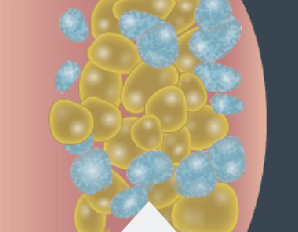 CoolSculpting® technology uses controlled cooling to target and destroy only these fat cells.*