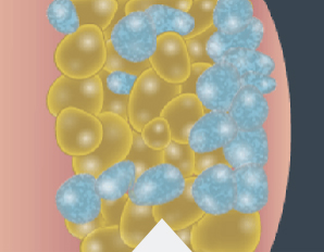 In the weeks that follow, your body naturally processes the fat and eliminates dead cells.*