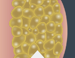 So treated fat cells are gone for&nbsp;good.*